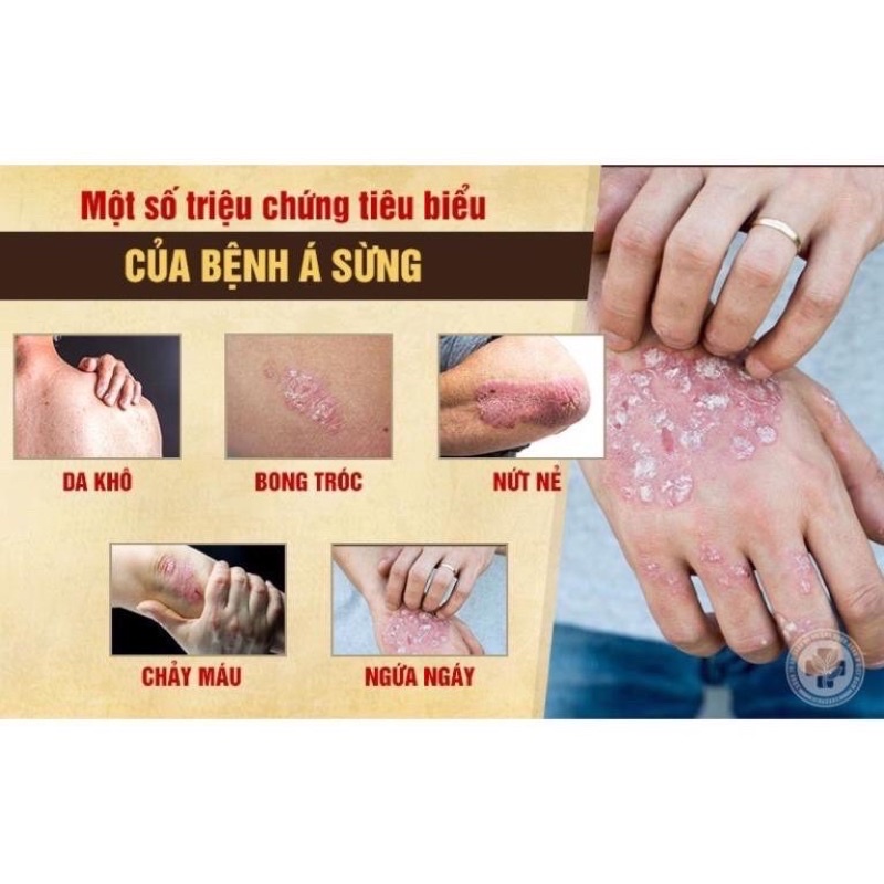 Kem bôi vẩy nến, á sừng, nứt gót chân, nước ăn chân tay