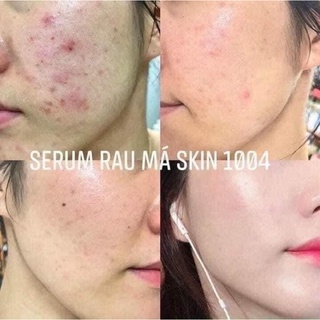 SERUM RAU MÁ CENTELLA SKIN1004 55ML