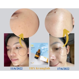 (Công ty) Tinh chất sáng da mờ nám sạm trx kyunglab