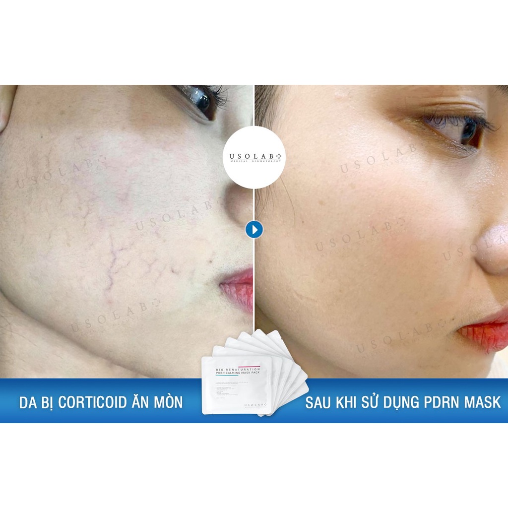 Combo PDRN Mask và HA ampoule 1.2ml USOLAB - Giúp phục hồi cấp nước đa tầng