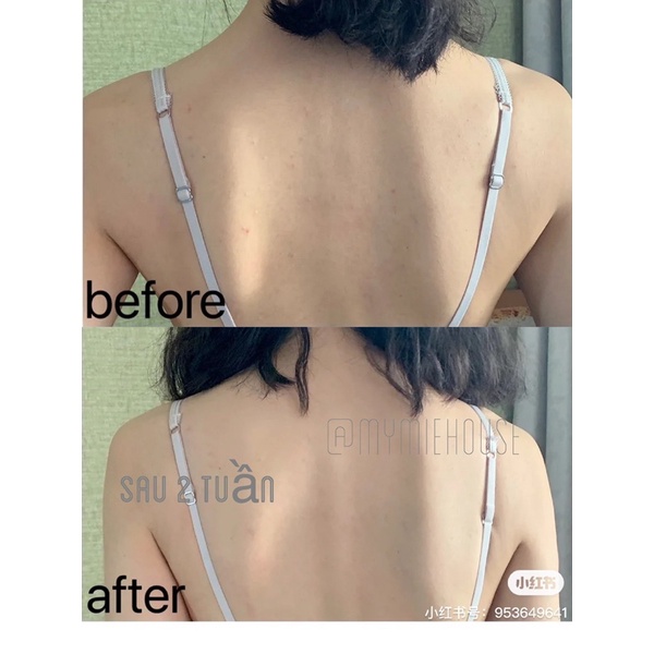 SOAP GIẢM MỤN LƯNG KOJIE.SAN.