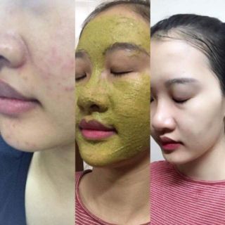 Thảo dược đắp mặt Tuệ Đức( xem ảnh thật khách dùng phía sau)
