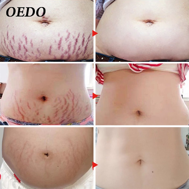 OEDO Rose Remove Stretch Marks Cream 40g | BigBuy360 - bigbuy360.vn