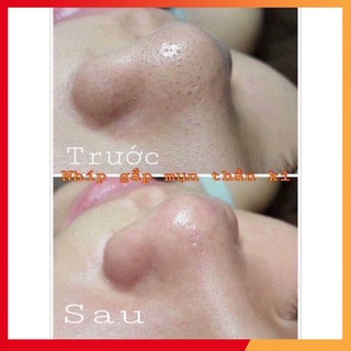 NHÍP GẮP MỤN THẦN THÁNH
