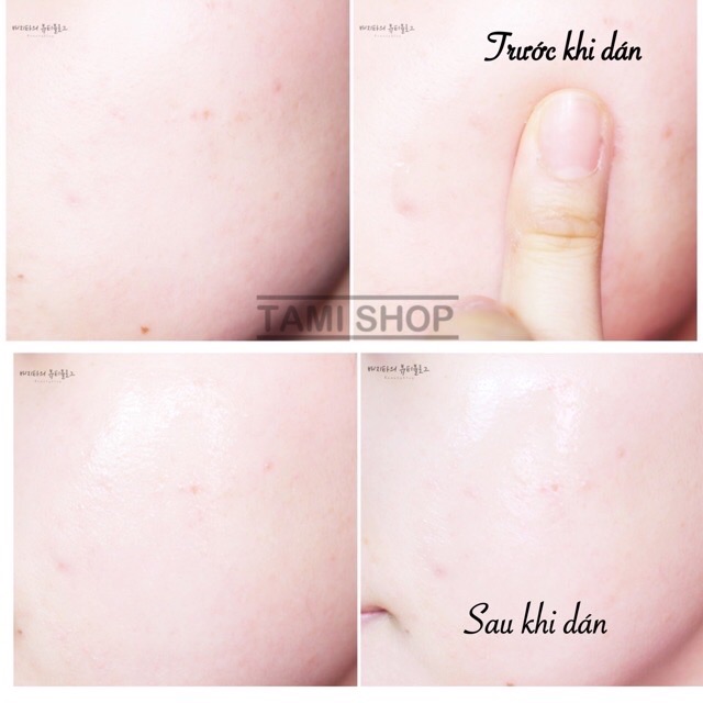 GEL DÁN MỤN PRRETI SECOND SKIN PATCH | BigBuy360 - bigbuy360.vn