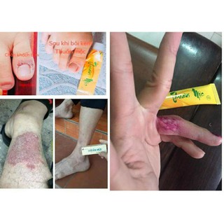Kem bôi da Thuần khắc tinh của da Mộc