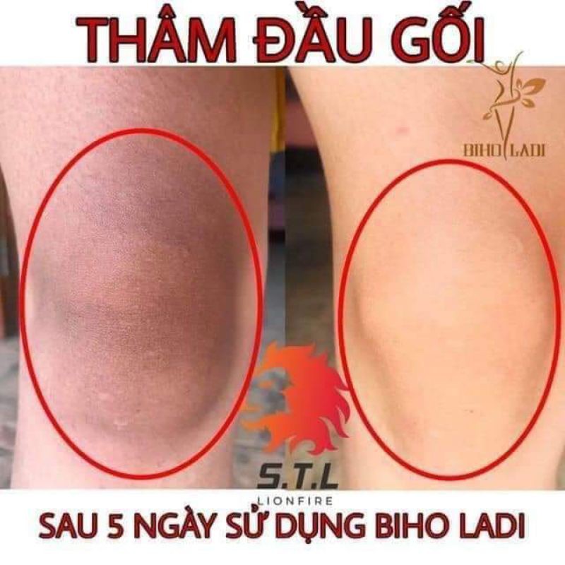 BIHO_LADI SIÊU DƯỠNG THÂM 5S ĐÁNH BAY THÂM NÁCH, BIKINI, MÔNG