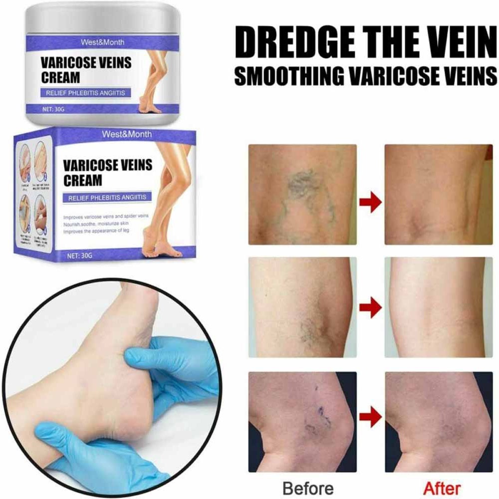 Vein Care Fading Cream Varicose Veins Cream for Legs Veins Herbal Ointment