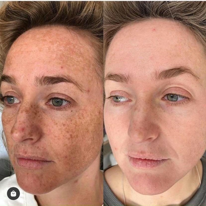 Kem giảm nám cao cấp Mesoestetic cosmelan 2