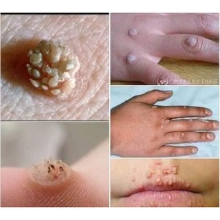 Chấm Mụn Cóc, Mụn Cơm, Chai Sần Hiệu Quả