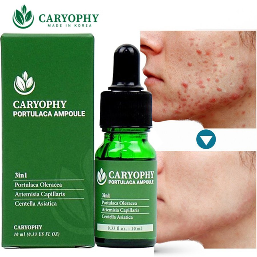 Combo 2 sản phẩm tinh chất làm sạch mụn và nước hoa hồng dưỡng trắng da caryophy portulaca - Lamicare