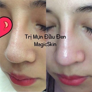 GEL LỘT MỤN ĐẦU ĐEN Magic
