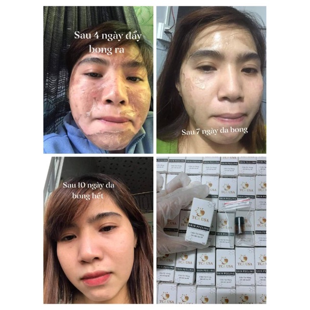 SÉT TCA CHẤM PEEL NÁM TÀN NHANG 35%