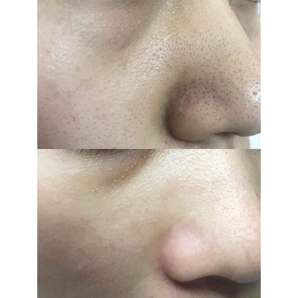 [ Chính hãng ] DUNG DỊCH Ủ MỤN MEDIPEEL CHUYÊN DÙNG SPA 100ml | BigBuy360 - bigbuy360.vn