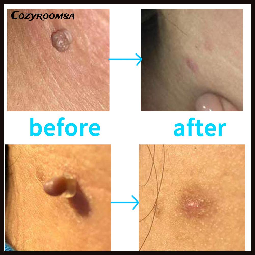 Bộ 30 Miếng Dán Loại Bỏ Thịt Thừa Trên Da Tiện Dụng