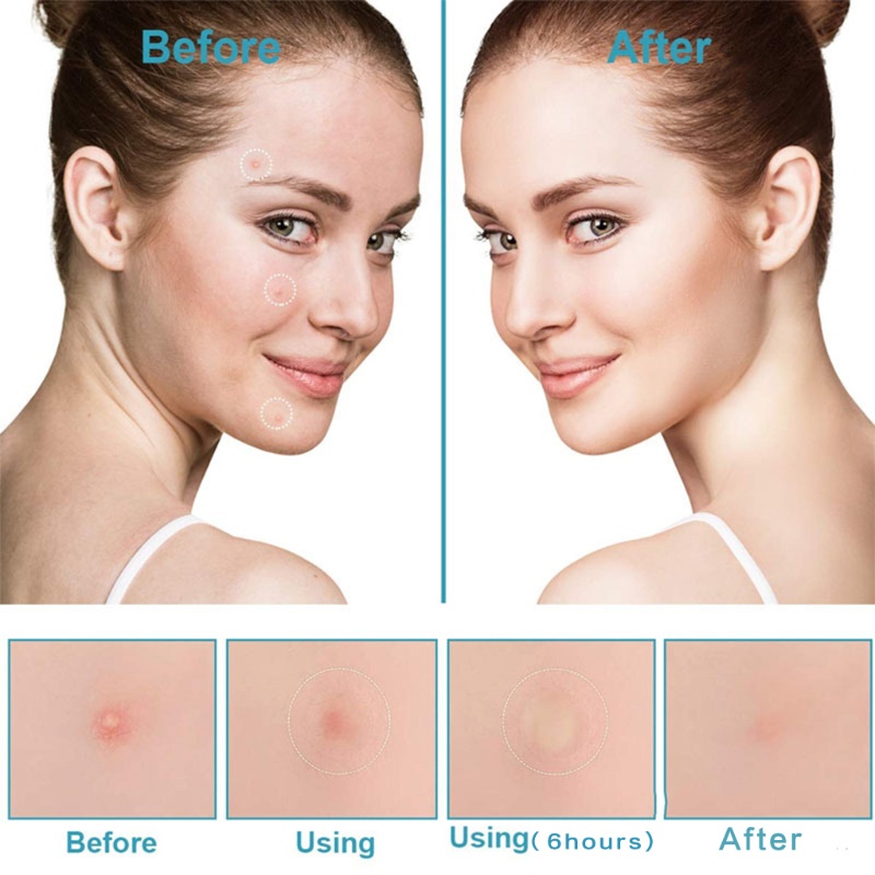 Set 3 Miếng Dán 108 Miếng Dán Mụn Trứng Cá Hấp Thụ Tốt