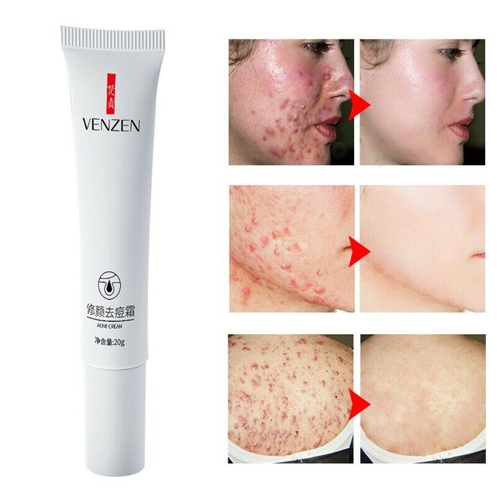 Kem Bôi Ngừa Mụn VENZEN 20g NO.FZ54857