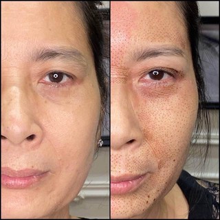 Máy nhấn mí Plasma XÓA MỤN LỐT RUỒI