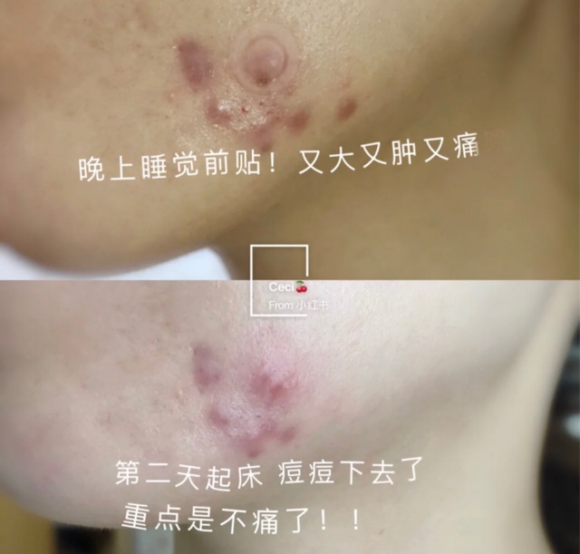 Miếng dán mụn Careplus Olive Young / Care Plus Scar Cover Spot Patch