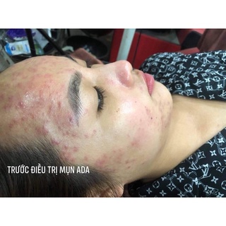 Serum Mụn Ẩn ADA 10+ -  MELA White ADA - 5ml