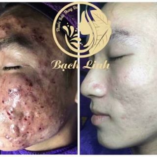 THUỐC THAY DA BẠCH LINH 02. CHUYÊN MỤN