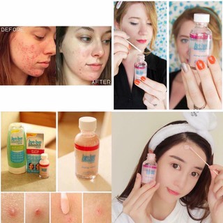 Kem chấm xẹp mụn Bye Bye Blemish Drying Lotion
