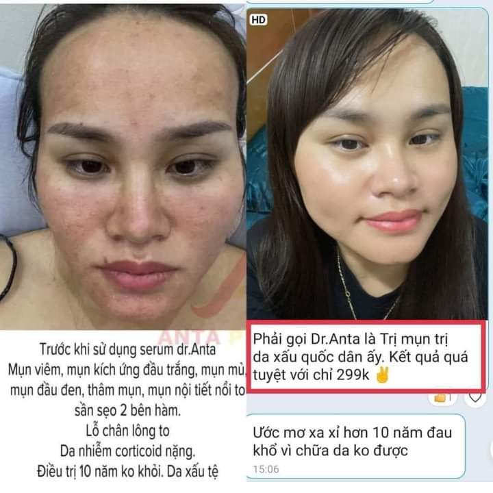 Serum  Dr.ANTA giảm mụn thâm rỗ -Công dụng 5 trong 1 hiệu quả trong 7 ngày