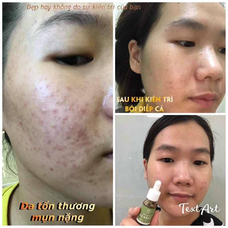 SERUM MỤN DIẾP CÁ - THIÊN NHIÊN 100% - CẢI THIỆN SAU 7 NGÀY - SERUM IGREEN