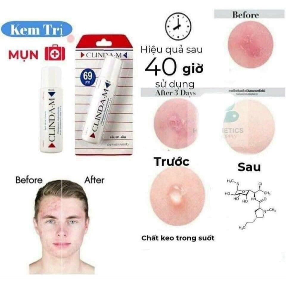 Gel Chấm Các Loại Mụn Clinda-M Thái Lan
