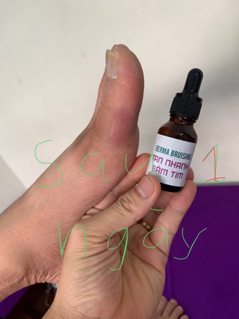 Gel bôi tan nhanh bầm tím - giảm sưng nề do chấn thương-sau thẩm mỹ DERMA BRUISING