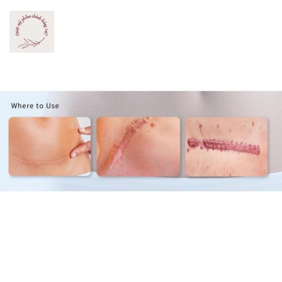 Kem mờ Sẹo Forscar - được tin dùng tại châu Âu & Mỹ