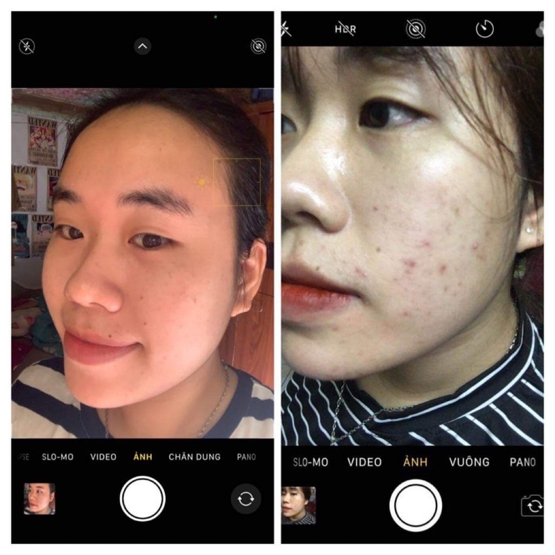 Serum mụn Nhà Bơ