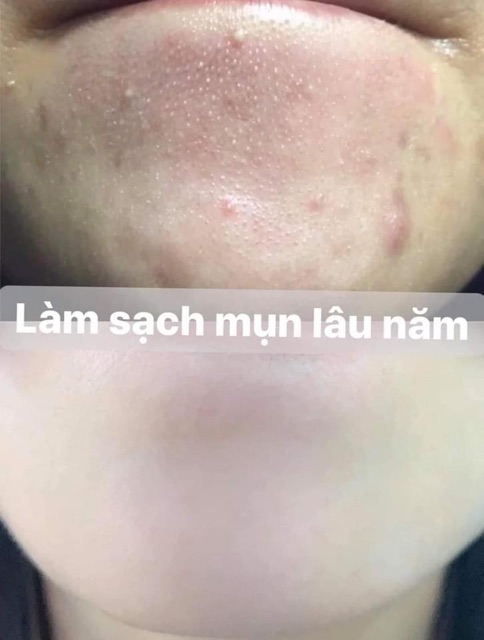 Kem đẩy mụn Acnetin A hết mụn ẩn, nếp nhăn