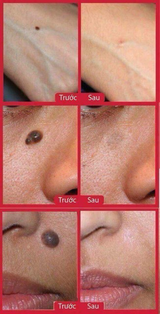 Tẩy Mụn Ruồi Nga | BigBuy360 - bigbuy360.vn