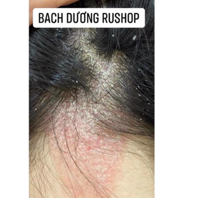 Kem bôi da cơ địa, viêm da dị ứng Belosalic Nga 30gr - Bachduongrushop