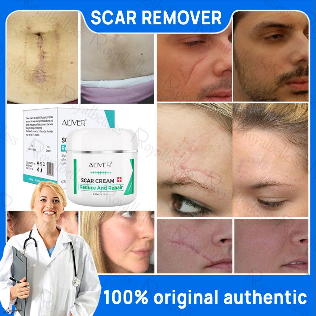 Aliver Sửa Chữa Sẹo Kem Sẹo In Làm Mịn Sửa Chữa Loại Bỏ Sẹo Kem Điều Trị Kem 50ml ALIVER Sửa Chữa Sẹo Vết Sẹo Kem đánh Dấu Loại bỏ Căng Bỏng Mổ Vết Sưng Phẫu Thuật Vết Sẹo ampere