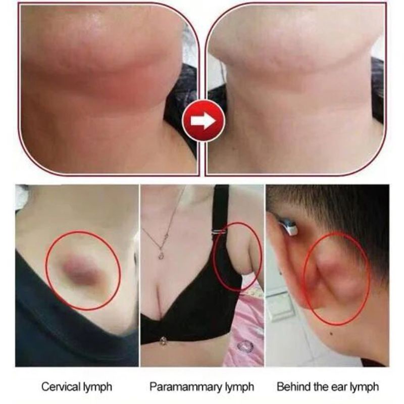 Miếng Dán Thải Độc Vùng Cổ Chống Sưng
