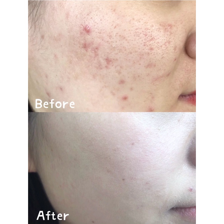 Hộp 60 Miếng Dán Cotton acid EIIO Salicylic acid Hỗ trợ giảm mụn Đầu Đen Thu Nhỏ Lỗ Chân Lông