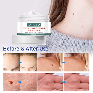 Vova Loại Bỏ Mụn cóc Kem Trị Mụn Kháng Khuẩn Loại Bỏ SkinTag Papillomas Chống Chân Ngô Mụn cóc Chiết Xuất Thảo Dược