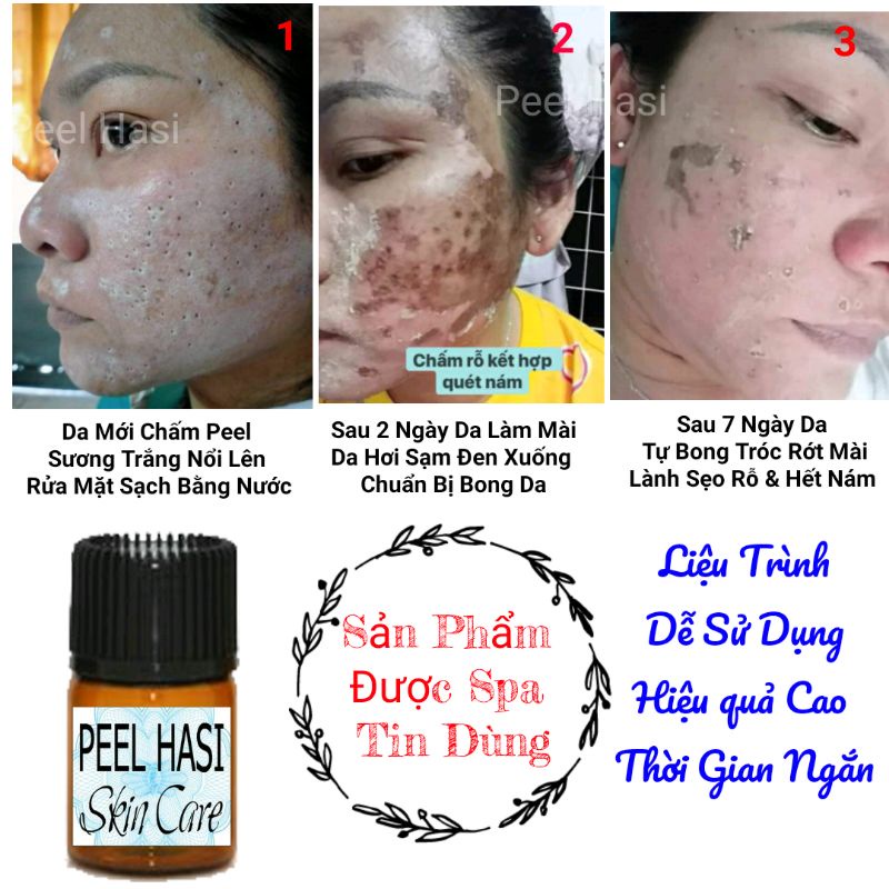 Chấm Đầy SẸO RỖ Lâu Năm. Quét Nám Tàn Nhang Peel HA SI