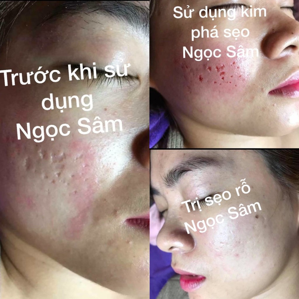 Ngọc Sâm Ngừa Sẹo Rỗ, Mụn