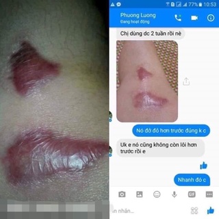 Kem sẹo Collagen