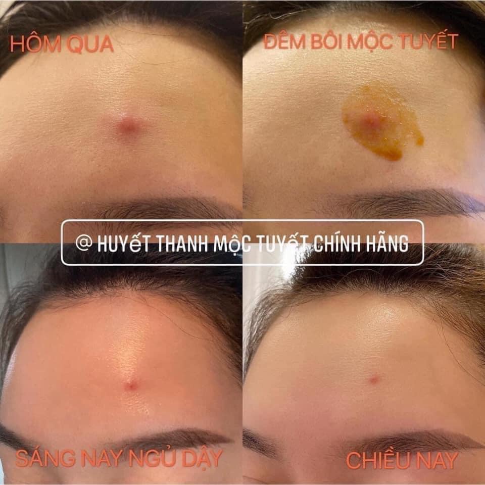 [Chính hãng] Serum huyết thanh mụn Mộc Tuyết, sạch mụn thâm, dưỡng da trắng phục hồi da căng bóng | BigBuy360 - bigbuy360.vn