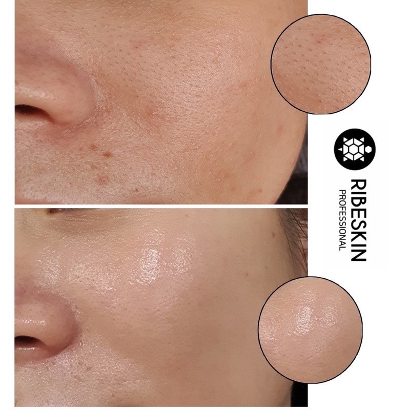 Bộ mặt nạ sạch sâu căng bóng CO2 Carboxy Sound Ribeskin