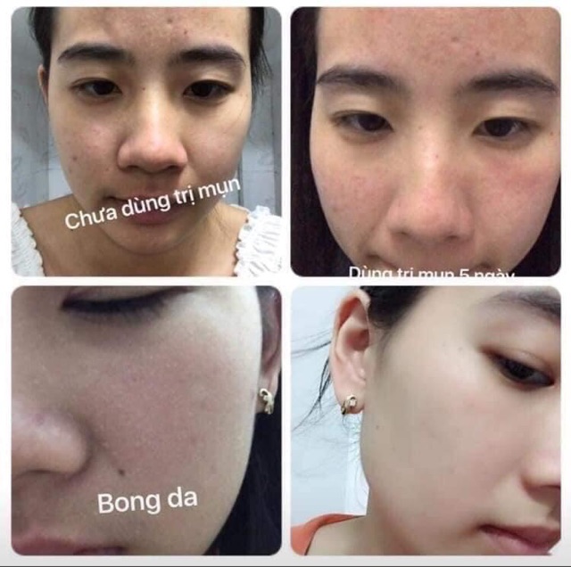 [mẫu mới] SERUM TINH CHẤT MỤN TÁI TẠO Linhzhi DR.LACIR - sạch mụn, trắng da