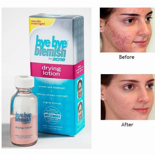 Dung Dịch Chấm Xẹp Mụn Sưng Sau MỘT ĐÊM Bye Bye Blemish Drying Lotion 29.5ml