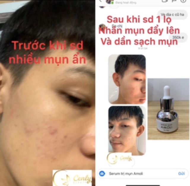 Serum mụn Amoli Cenly | BigBuy360 - bigbuy360.vn