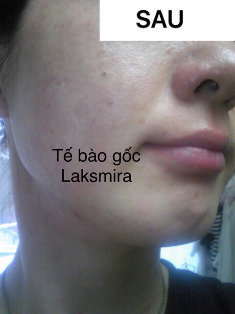 Tế bào gốc Laskmira a hộp 10 ống 5ml Hàn Quốc