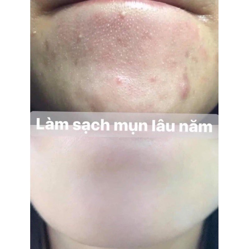 ( Tretinoin 0.025 - Tretinoin 0.05 )  Kem Đẩy Mụn Retin A mới Acnetin A Thái