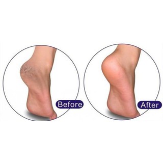 KEM TRỊ NỨT GÓT CHÂN SCHOLL